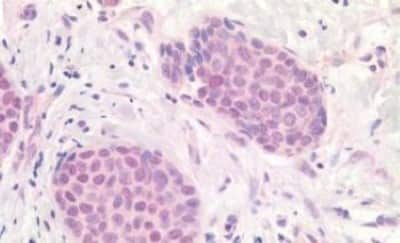 Immunohistochemistry-Paraffin: APOBEC3B Antibody [NBP3-14542] - Human Breast Carcinoma: Formalin-Fixed, Paraffin-Embedded (FFPE)